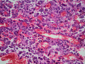 View of lung tissue under a microscope that used a HE stain to show adenocarcinoma, a type of cancer.