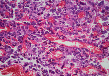 Lung Cancer Immunotherapy Approved for Use Before and After Surgery 