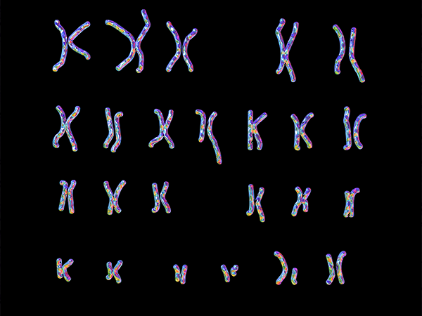 A set of chromosomes, including the Philadelphia chromosome abnormality, which can form in chronic myeloid leukemia patients.