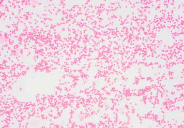 New Targeted Therapy for Myelodysplastic Syndromes