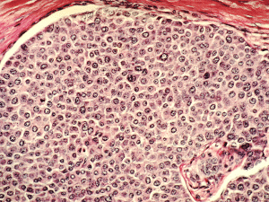 Histological slide of breast cancer cells, which shows the duct on inside of the breast  completely filled with tumor cells.