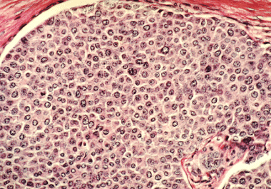 New Targeted Therapy for Hormone Receptor-positive Breast Cancer 