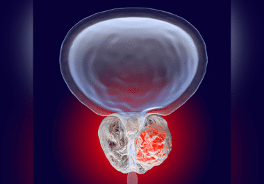 Hormone Therapy for Early-stage Prostate Cancer