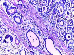 A micrograph of stomach cancer where the glands are seen infiltrating the muscle layer.