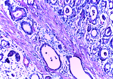 First-line Immunotherapy for Stomach Cancer