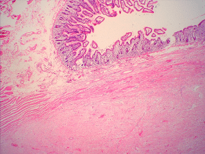 View of an intraabdominal desmoid tumor, which can extend through the bowel to the mucosa and provoke ulceration.