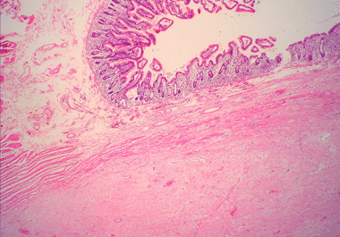 First FDA-approved Treatment for Desmoid Tumors