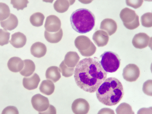 Blood smear of chronic lymphocytic leukemia where effected areas are highlighted in purple.
