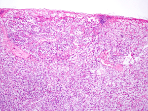 A micrograph showing a renal clear cell carcinoma (RCC) nodule, which is a type of kidney cancer.
