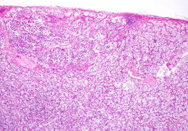Expanded Indication for Kidney Cancer Drug 