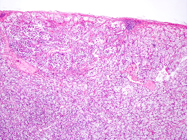 Expanded Indication for Kidney Cancer Drug | AACR