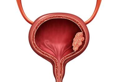 Erdafitinib Granted Full Approval for Bladder Cancer