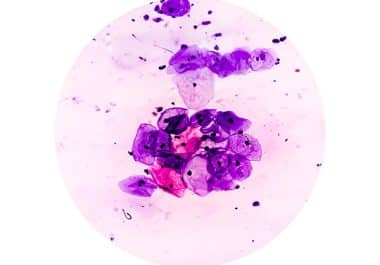 Pembrolizumab Plus Chemoradiotherapy Approved for Cervical Cancer 