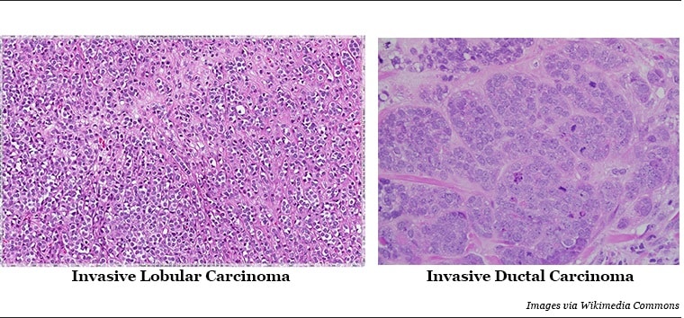 Two images: On the left are magnified invasive lobular carcinoma cells with purple nuclei in a pink matrix. Cells exist in tiny clusters or in fiber-like lines. On the right is a magnified image of invasive ductal carcinoma cells with purple nuclei, arranged in cohesive clumps in a pink matrix. 