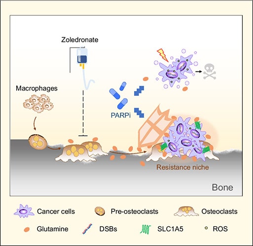 A graphic depicting macrophages as a grouping of five small squiggly blobs. An arrow points down to them becoming pre-osteoclasts, which is a more oval shaped object with three yellow circles inside. An arrow points from the pre-osteoclasts to it becoming osteoclasts which is shaped as a larger brown oval but with squiggly legs in white and orange circles inside. Above these is an IV bag labeled zoledronate with a line pointing down from the IV to the  osteoclasts. An arrow points from the osteoclasts to cancer cells depicted as one large purple blob with smaller darker purple ovals inside. This cancer cell is protected by an image of a shield. Above the shield are blue medicine capsules labeled as PARPi with blue arrows pointing toward the shield and above it where there are smaller cancer cells being attached by an orange lightning bolt. An arrow points from those cancer cells to a skull and bones.  