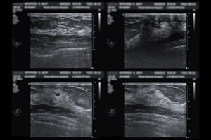 Four screens from an ultrasound of a breast with cancer.