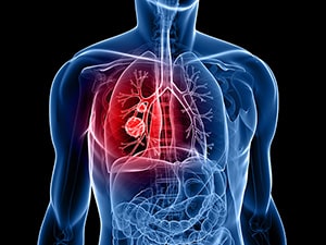 An illustration of a transparent human torso, inside of which the lungs, spine, and several gut organs are visible. The patient’s right lung contains two spherical tumors, shown in red to indicate lung cancer.