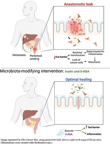 Two illustrations: Both include the outline of a human figure in black and white from the torso up with the colon and liver drawn in color within the abdomen and a second image in a box to the right to show a close-up of inside the colon. In the top image, bacteria and cancer cells are leaking out of the colon, and a tumor has grown on the liver. In the bottom image, the colon has remained sealed to show optimal healing with no leakage.