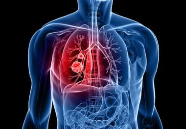 Full Approval Granted to MET Inhibitor for Lung Cancer