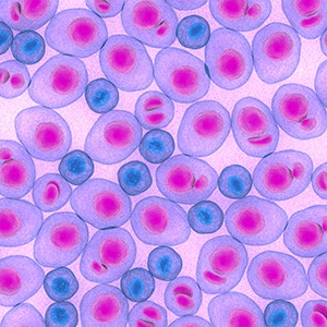 An illustration of multiple myeloma cells using blue, purple, and pink hues. 