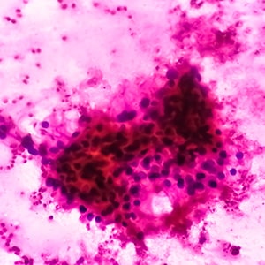 Microscopic image of clear cell carcinoma, one of the most common types of kidney cancer.