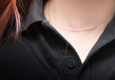 How can I address scars from cancer surgery?