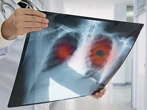 Photograph of a physician holding a chest X-ray. In the X-ray, the lungs are highlighted in red, and one has a tumor, shown in black, indicating lung cancer.