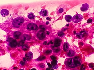 Magnified image (200x) of metastatic lung cancer cells. 