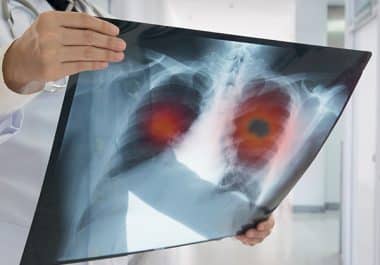 Full Approval and New Combination for Amivantamab-vmjw 