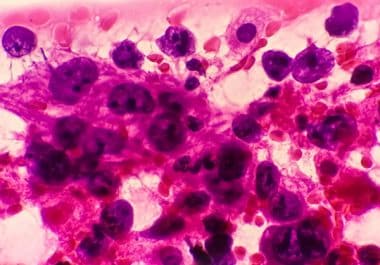 EGFR Inhibitor Plus Chemotherapy Approved for Certain Lung Cancers 