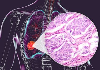 Kinase Inhibitor Approved for Resectable Lung Cancer