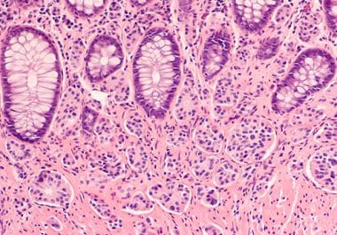 First Targeted Radiotherapy for Certain Pediatric Neuroendocrine Tumors 