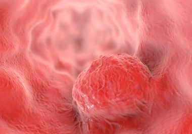 A New Immunotherapy for Esophageal Cancer 