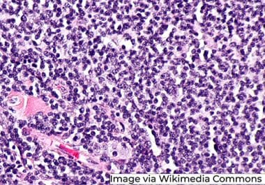 Bispecific Antibody Expands Reach to Follicular Lymphoma