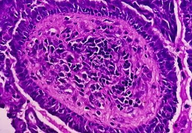 Durvalumab Approved for Endometrial Cancer