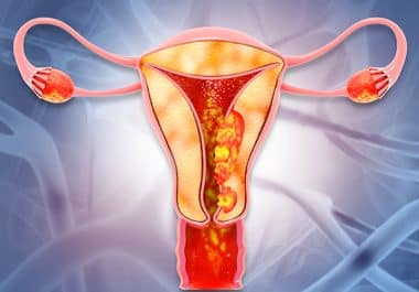 Endometrial Cancer Indications Expanded for Pembrolizumab
