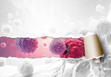 TILs in Solid Tumors