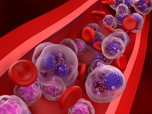 A New Multiple Myeloma Indication for Daratumumab and Hyaluronidase ...