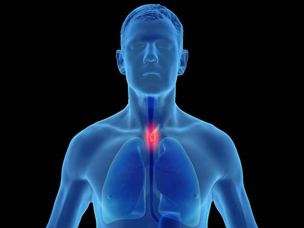 The FDA has approved a new combination regimen for certain patients with esophageal cell squamous cell carcinoma.