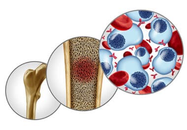 New Bispecific T-cell Engager Approved for Multiple Myeloma 