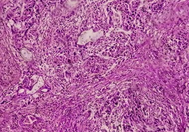 New Intravesical Treatment System Approved for Early-stage Bladder Cancer 