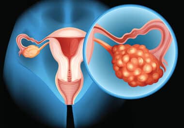 Shining a Light on New Approaches for Ovarian Cancer Treatment and Detection
