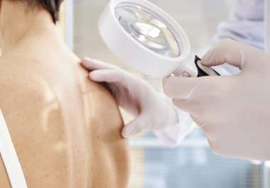 Immunotherapy Approved for Preventing Recurrence of Certain Skin Cancers