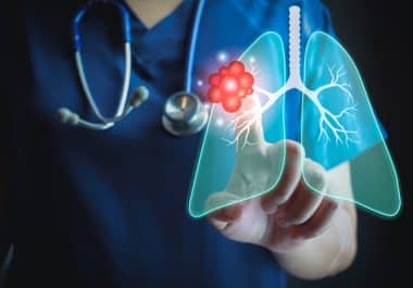 Treatment Combination Improves Survival in EGFR-positive Lung Cancer