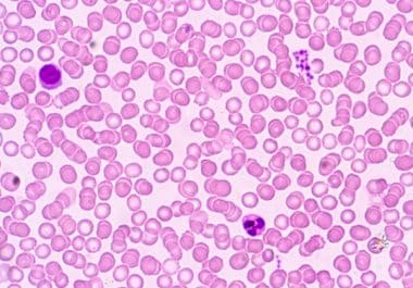 Combination Therapy With Antibody-drug Conjugate Approved for Multiple Myeloma