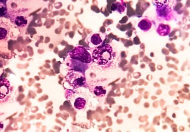 First Approved Treatment for Adults with High-risk Smoldering Multiple Myeloma