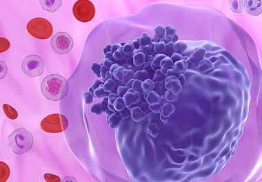 Ziftomenib Approved for Certain Acute Myeloid Leukemias