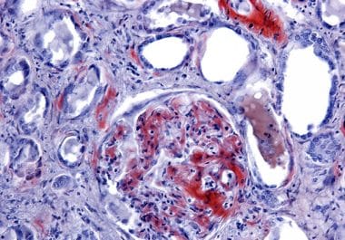 Monoclonal Antibody Therapy Approved for Adults with Newly Diagnosed Light-chain Amyloidosis