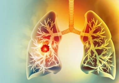 Immunotherapy Approval Marks Progress in Small Cell Lung Cancer