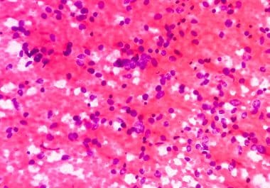 T-cell Engager Approved for Aggressive Lung Cancer